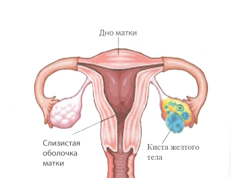 Киста желого тела.