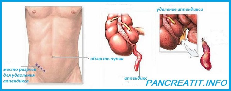 Где находится аппендицит?