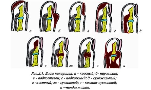Виды панариция.