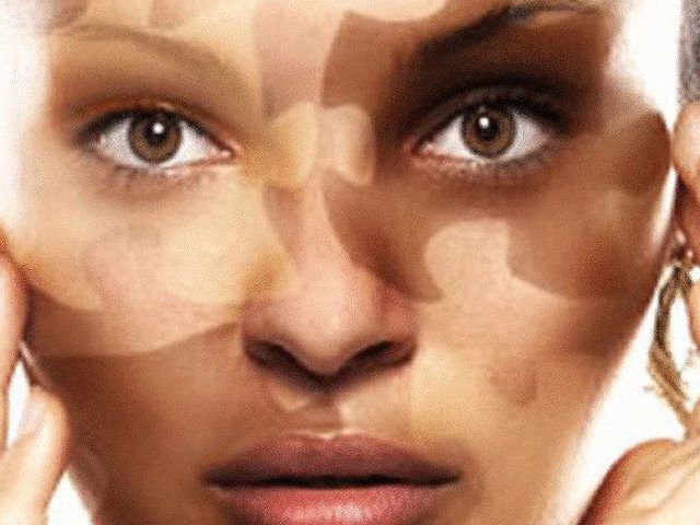 Что за болезнь витилиго? Витилиго: начальные симптомы, причины, виды, лечение и профилактика у взрослых и детей