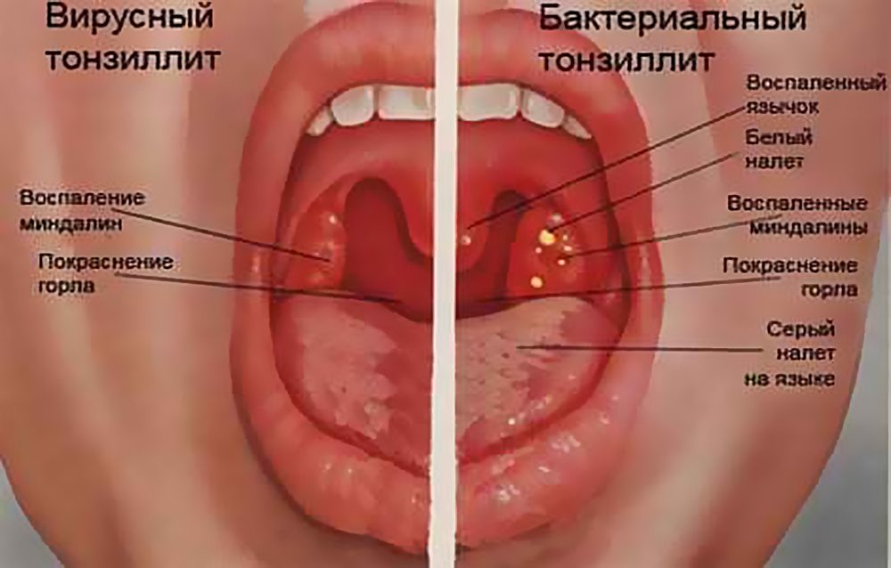 Виды ангины (тонзиллита)