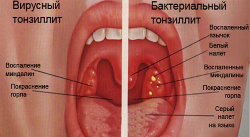 Как возникает бактериальный тонзиллит