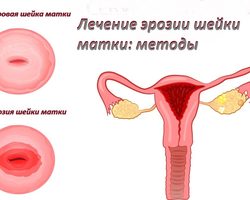 Эрозия шейки матки — что это такое: симптомы, признаки, диагностика. Современное лечение эрозии шейки матки у гинеколога: радиоволнами, лазером
