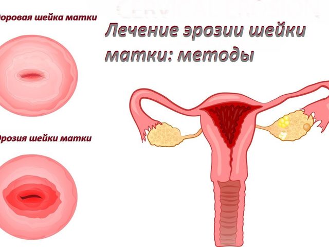 Эрозия шейки матки — что это такое: симптомы, признаки, диагностика. Современное лечение эрозии шейки матки у гинеколога: радиоволнами, лазером