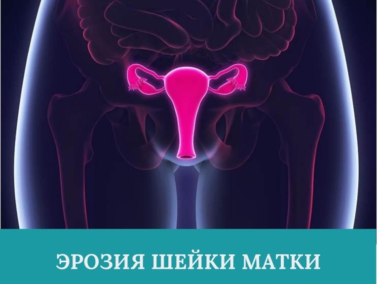 Эрозия шейки матки