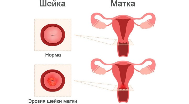 Эрозия шейки матки