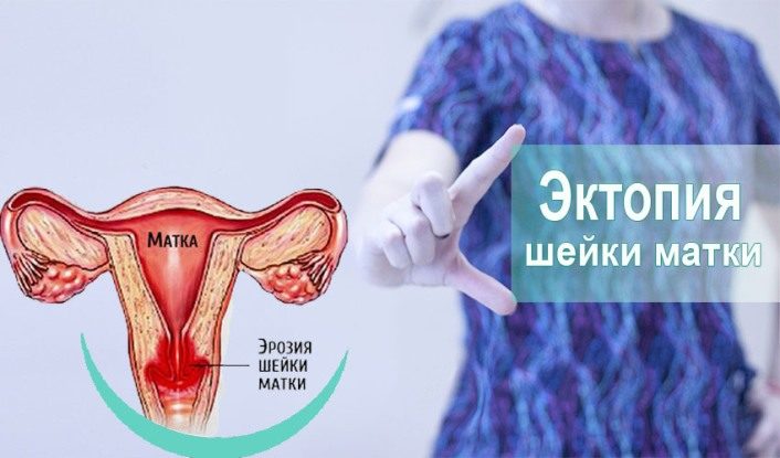 Эрозия шейки матки