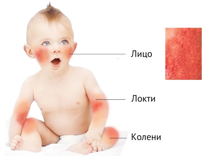 Лучшие эмоленты при атопическом дерматите у детей: список и названия препаратов