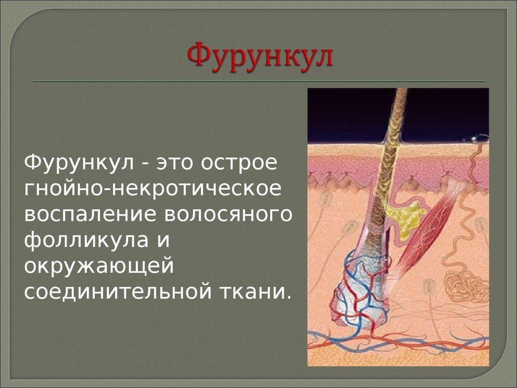 Фурункул