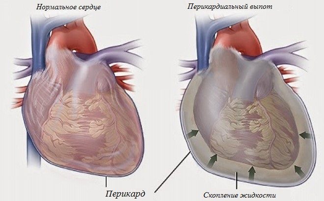 Гидроперикардит.