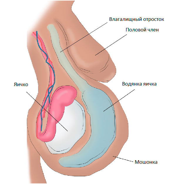 Гидроцеле.