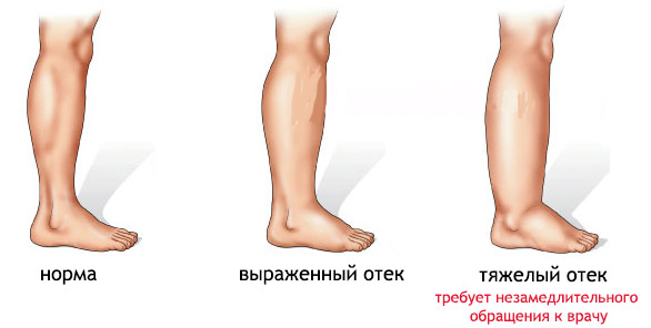 Выраженность водянки ног.
