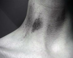 Как быстро избавиться от засоса на шее, как убрать, скрыть? Засос на шее у девушки, парня: что означает?