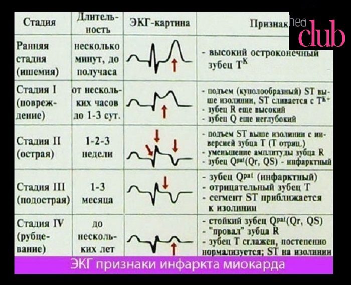 Расшифровка экг при инфаркте миокарда