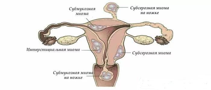 Классификация миом матки