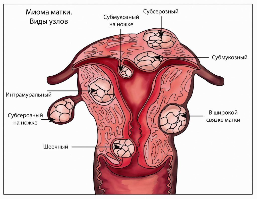 Множественная миома матки и беременность