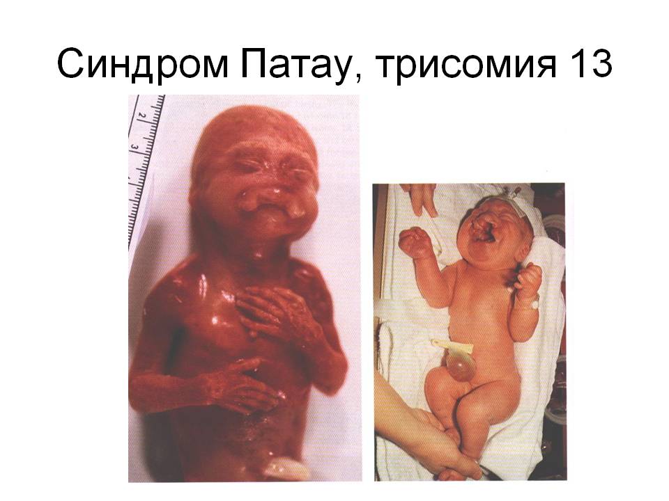 Синдром патау у детей: фото новорожденных