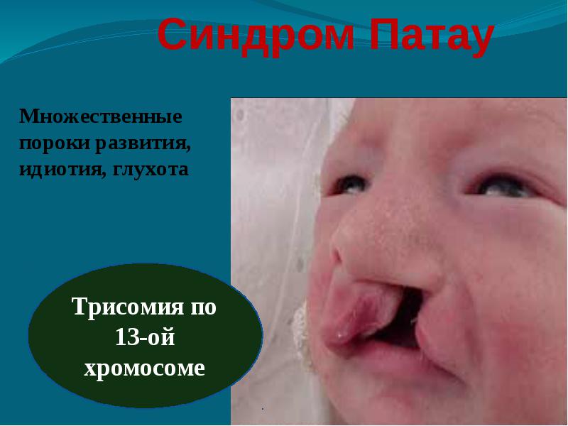 Синдром патау у детей: причины заболевания