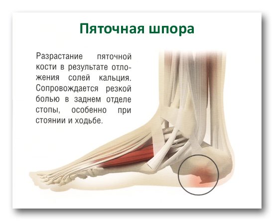 Пяточная шпора.