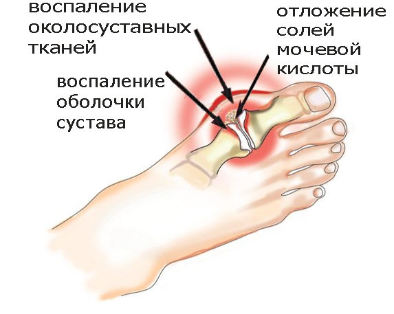 Подагра.