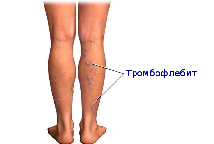 Тромбофлебит.