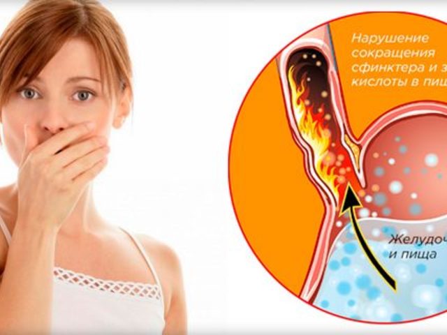 Отрыжка воздухом после еды, ком в горле, отрыжка постоянная и частая, с изжогой и икотой: причины и лечение. Отрыжка тухлыми яйцами: симптомы какой болезни? Как избавиться от отрыжки воздухом лекарствами и народными средствами и методами?
