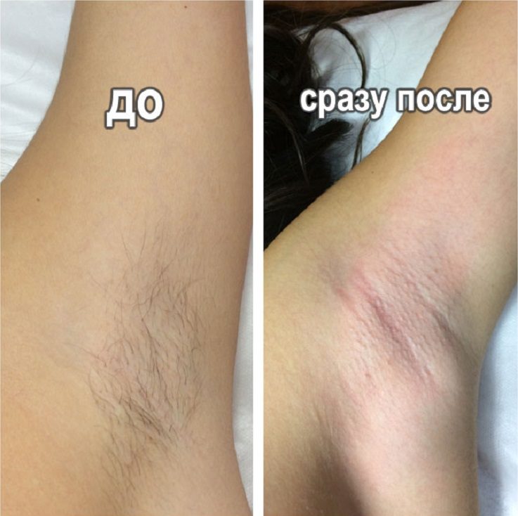 Шугаринг - фото: до и после