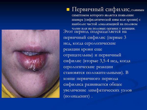 Первичный сифилис