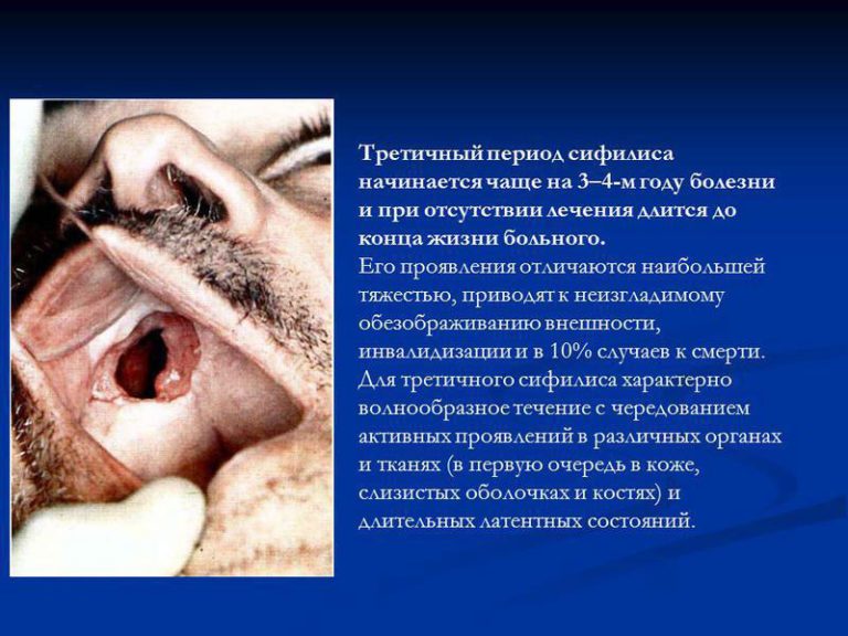 Третья стадия сифилиса