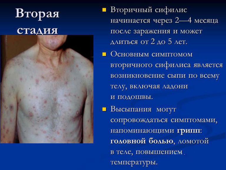 Вторая стадия сифилиса