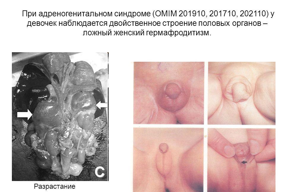 Как выглядят гениталии, половые органы людей гермафродитов: схема расположения