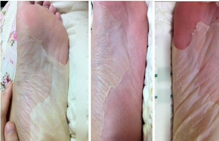 Как действуют носочки для педикюра?