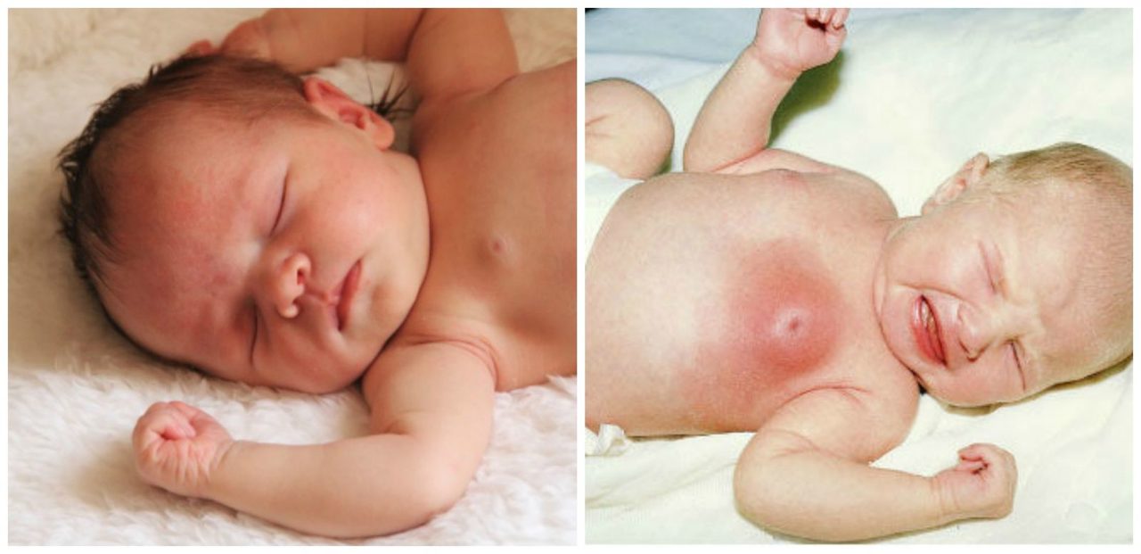 У новорожденной девочки и мальчика набухли, увеличены молочные железы: причины, опасно ли это?