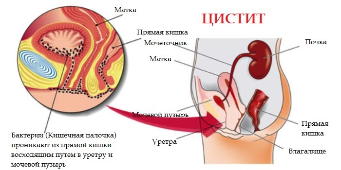 Средства от цистита для женщин