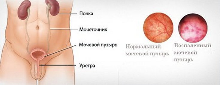 Средства от цистита для мужчин