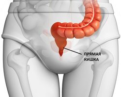 Рак прямой кишки: симптомы и причины, стадии, диагностика, лечение, прогнозы