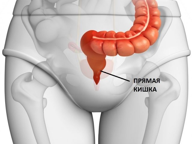 Рак прямой кишки: симптомы и причины, стадии, диагностика, лечение, прогнозы