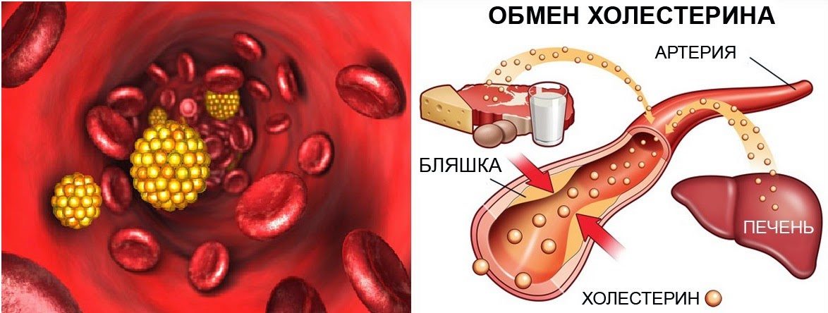 Что нельзя есть и делать при повышенном холестерине: советы