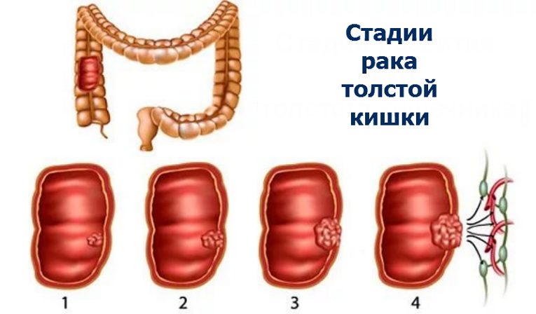 Стадии