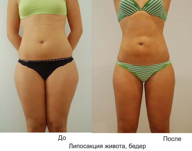 До и после процедуры