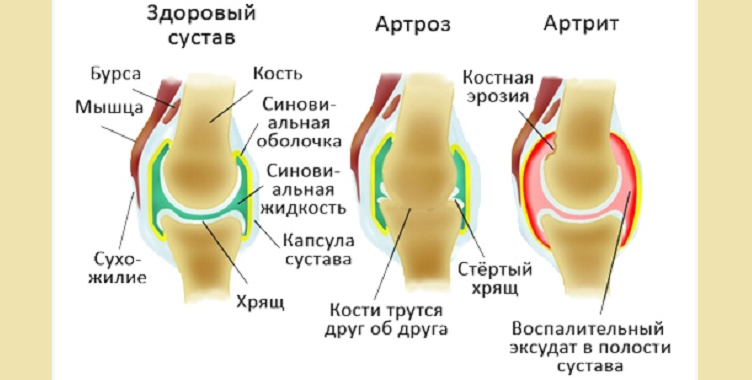 Отличие артрита от артроза