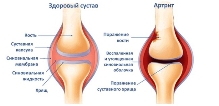 Первые признаки и симптомы артрита и артроза