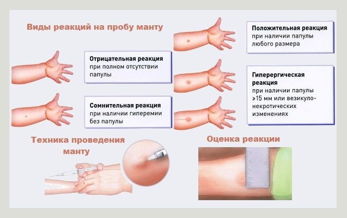 Виды реакций на пробу манту