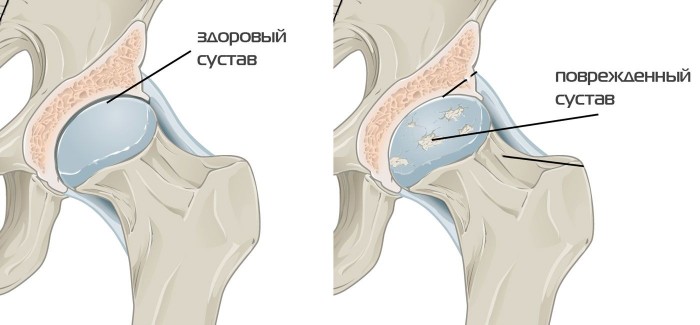 Боль в суставе бедра