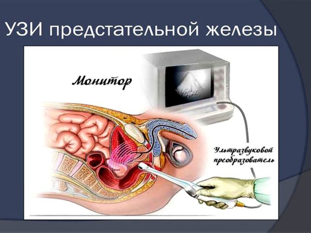 Как делать УЗИ предстательной железы трансректальным и трансабдоминальным способами, для чего УЗИ нужно делать, как нему подготовиться? В каких случаях врач назначает УЗИ предстательной железы? Какие результаты можно узнать по УЗИ предстательной железы?