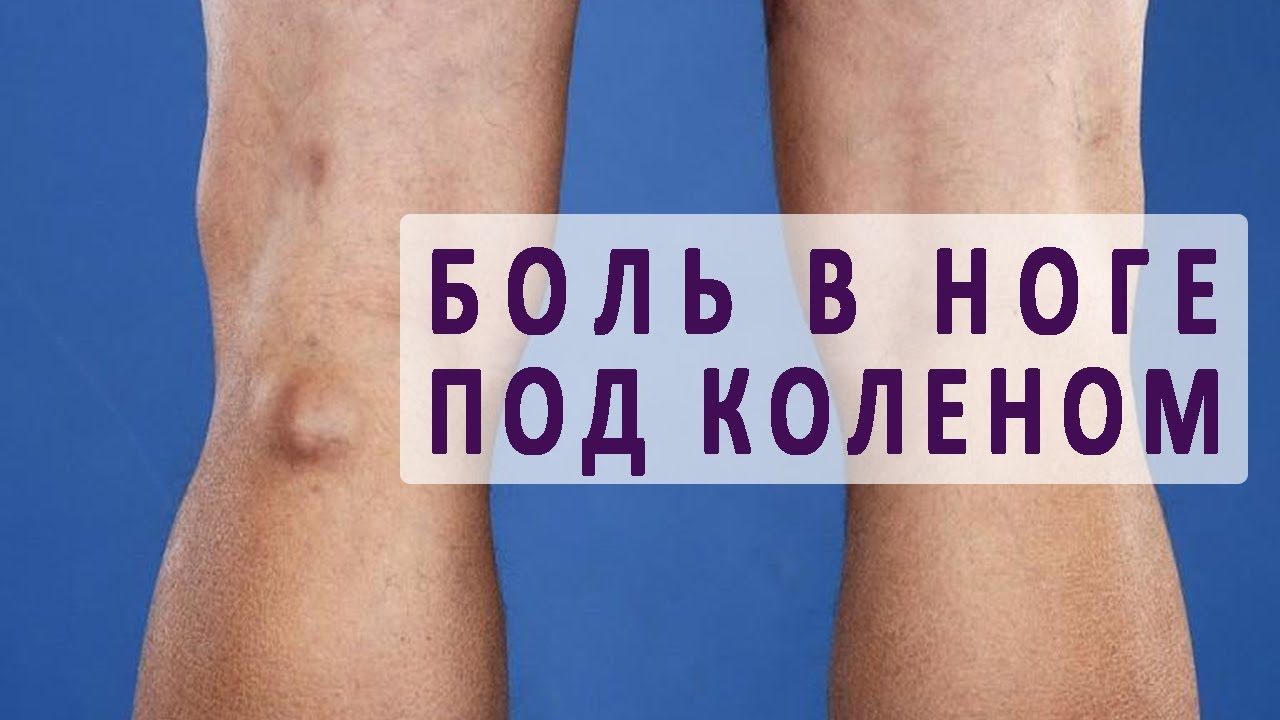 Боль в ноге в подколенной ямке