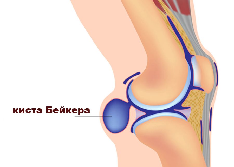 Киста бейкера