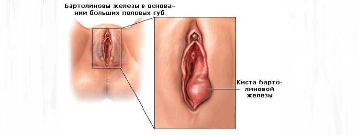 Бартолинит