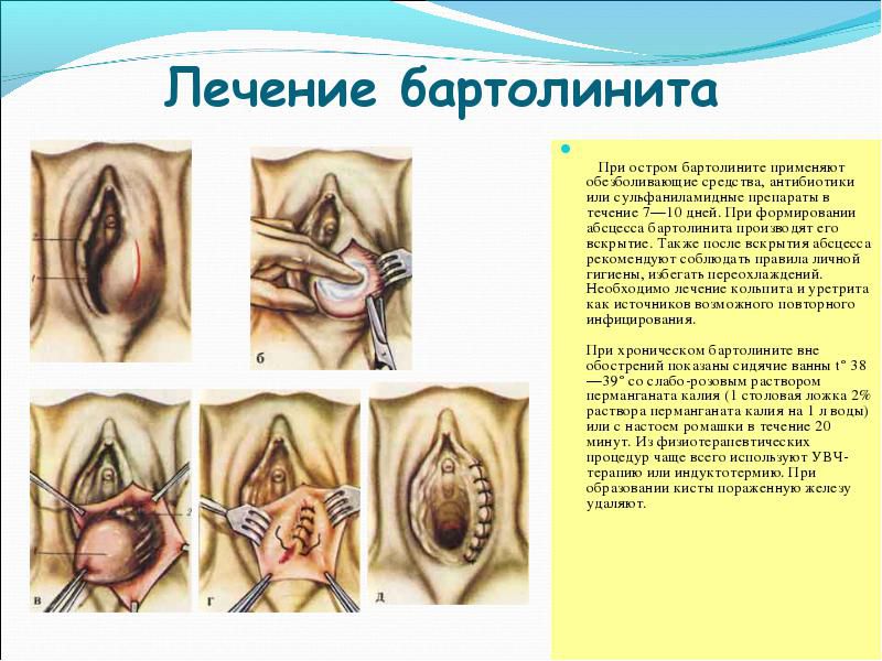 Операция для лечения бартолинита