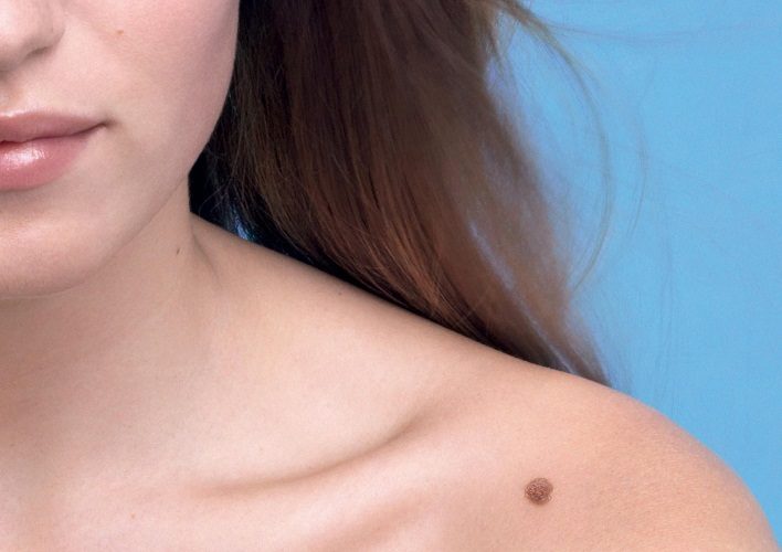 Родинки защищают нас от ультрафиолетового излучения